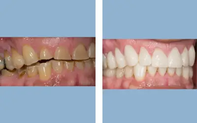 Before and After
